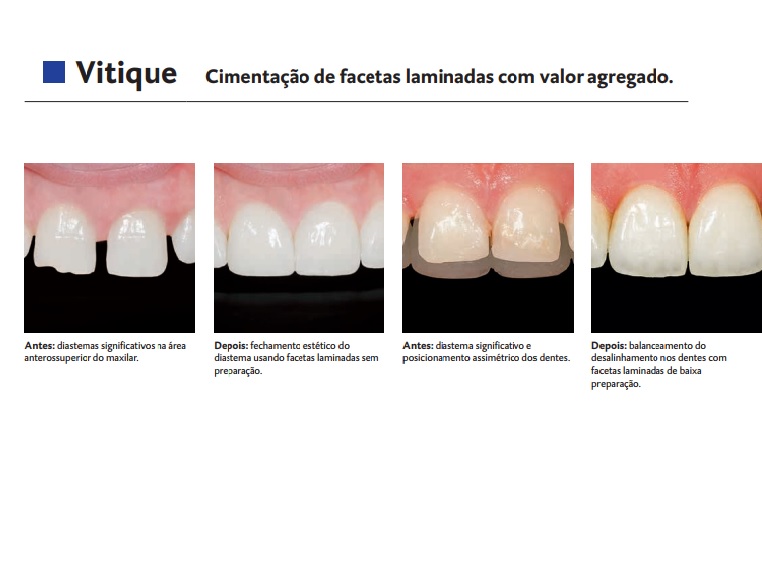 Infográfico do produto Cimento Resinoso Vitique Basis A1 Infográfico do produto Cimento Resinoso Vitique Basis A1